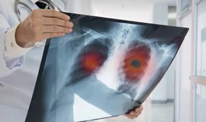 Λάρισα: Στις 3 Ιουνίου θα λειτουργήσει το Ιατρείο Προσυμπτωματικού ελέγχου του καρκίνου του πνεύμονα