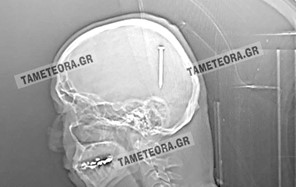 Καλαμπάκα: Καρφί 5 εκατοστών σφηνώθηκε στο κεφάλι άνδρα - Χειρουργήθηκε στο ΠΓΝΛ 