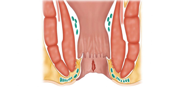 Ραγάδα πρωκτού: Ποια είναι τα πιθανά συμπτώματα και ποια η καλύτερη θεραπεία