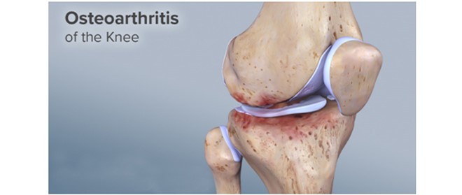 Αρθρίτιδα Γόνατος: Τι κάνω και πώς την αντιμετωπίζω;