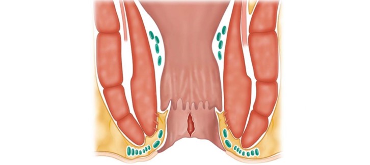 Ραγάδα πρωκτού: Ποια είναι τα πιθανά συμπτώματα και ποια η καλύτερη θεραπεία