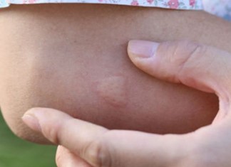 Προστατευτείτε από τα κουνούπια και ενυδατώστε την επιδερμίδα σας Προστατευτείτε από τα κουνούπια και ενυδατώστε την επιδερμίδα σας