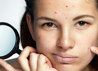 Αντιμετώπιση της ακμής Αντιμετώπιση της ακμής