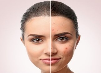 Αντιμετώπιση της ακμής Αντιμετώπιση της ακμής